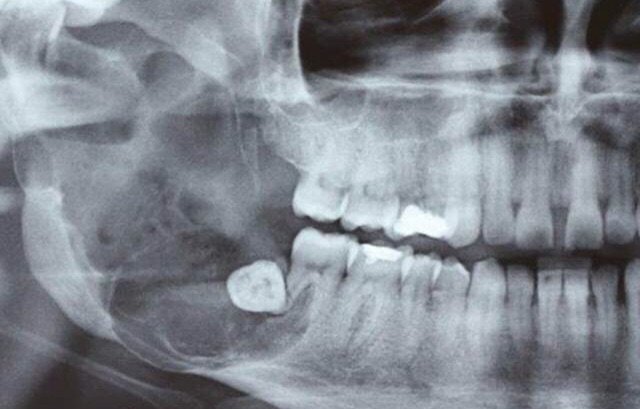 tumor odontogenico - Tumores Odontogênicos: A Importância do Diagnóstico Precoce