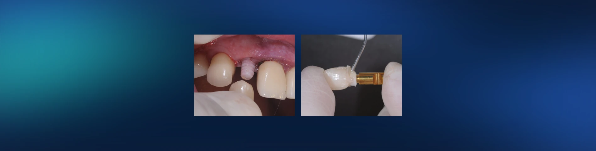 Dicas sobre confeccao de provisorios sobre implante - Consejos para la fabricación de provisionales sobre implantes