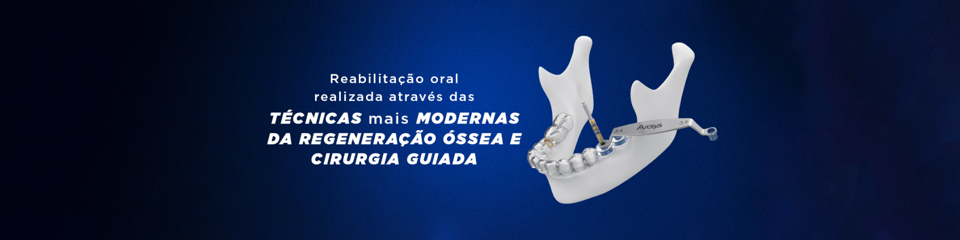 Reabilitacao oral realizada atraves das tecnicas mais modernas da regeneracao ossea e cirurgia guiada - Reabilitação oral realizada através das técnicas mais modernas da regeneração óssea e cirurgia guiada