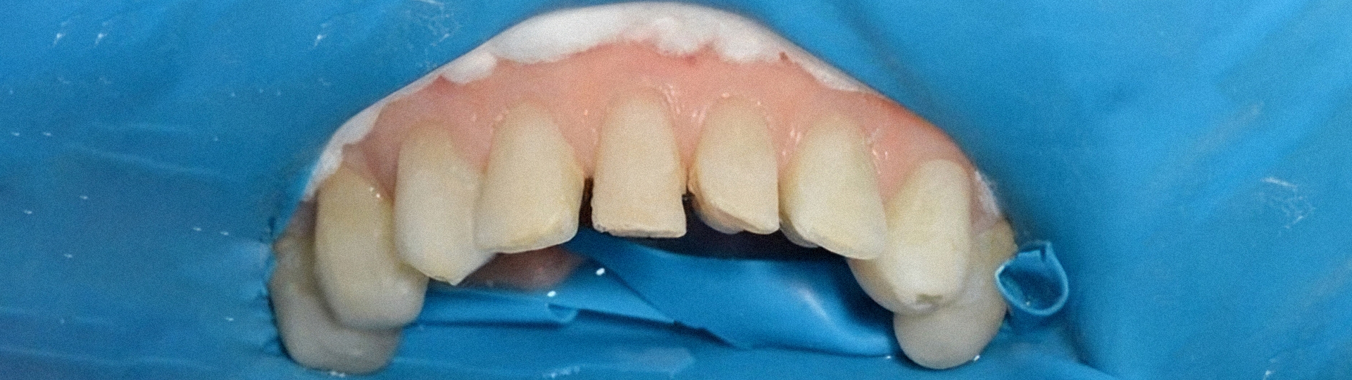 2 - Fechamento de diastema e correção de forma e volume dos dentes com resina composta Vittra APS