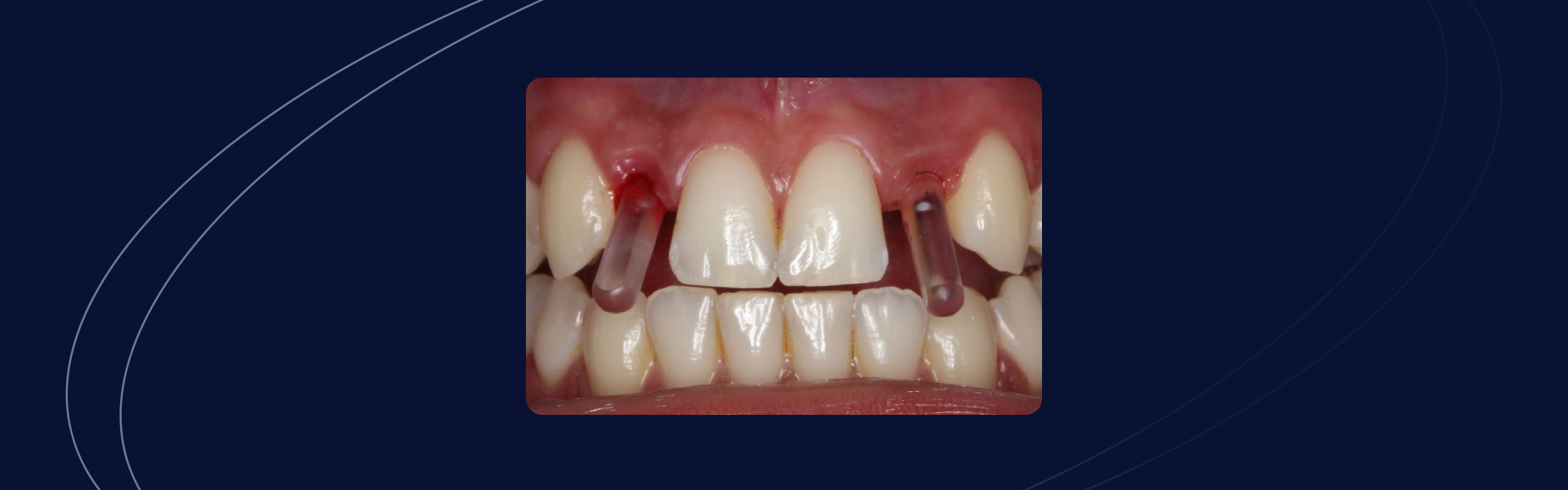 Cirurgia guiada em agenesia dentaria - Cirurgia guiada em agenesia dentária