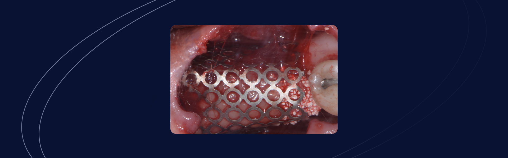 Reconstrucao em regiao posterior de mandibula e futura instalacao de implante guiado - Reconstrução em região posterior de mandíbula e futura instalação de implante guiado