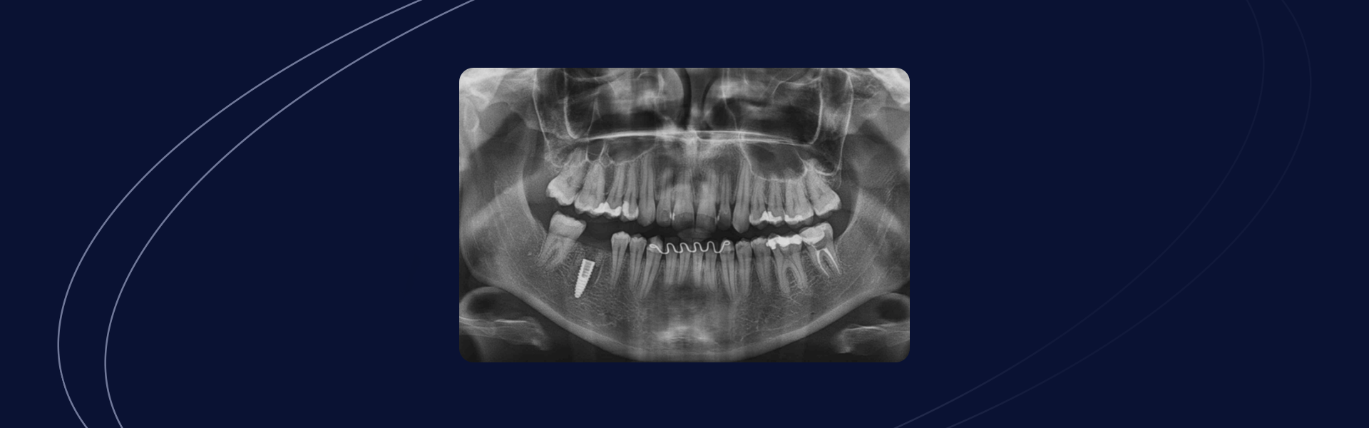 Implante Friccional em Regiao Posterior - Implante Friccional em Região Posterior – Acompanhamento de Caso – 4 anos