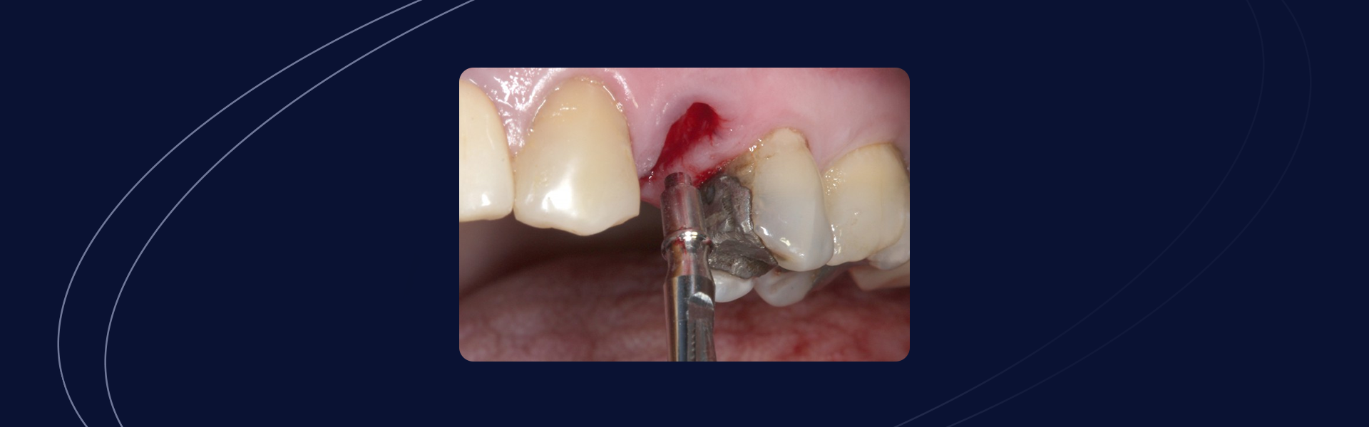 Implante imediato pos - Implante imediato pós-extração: Nanosynt e sistema Arcsys FGM – Manutenção de volume tecidual e excelência estética