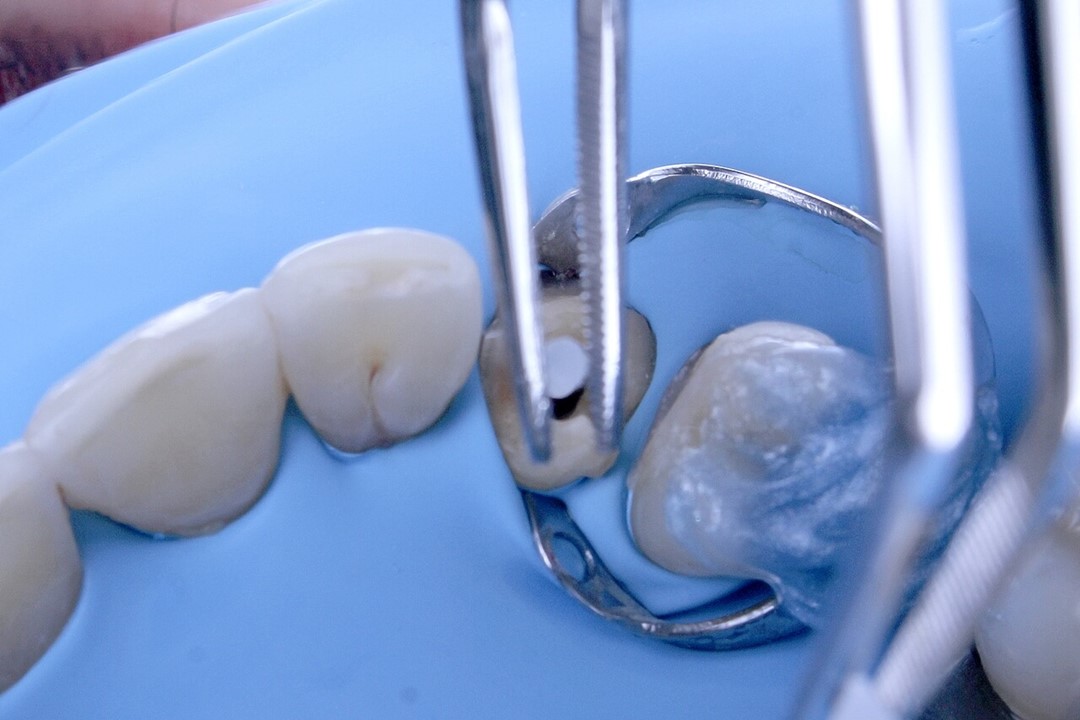 Kit Poteaux En Fibre De Verre Pour Dentisterie + 4 Forets - Haute Intensité - Neuf