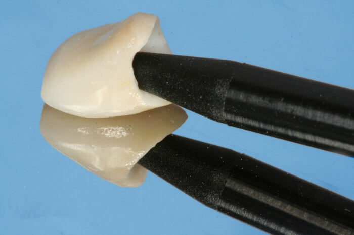 14 Cimentacao adesiva em coroas ceramicas livres de metal 14 - Adhesive cementation of metal-free ceramic crowns