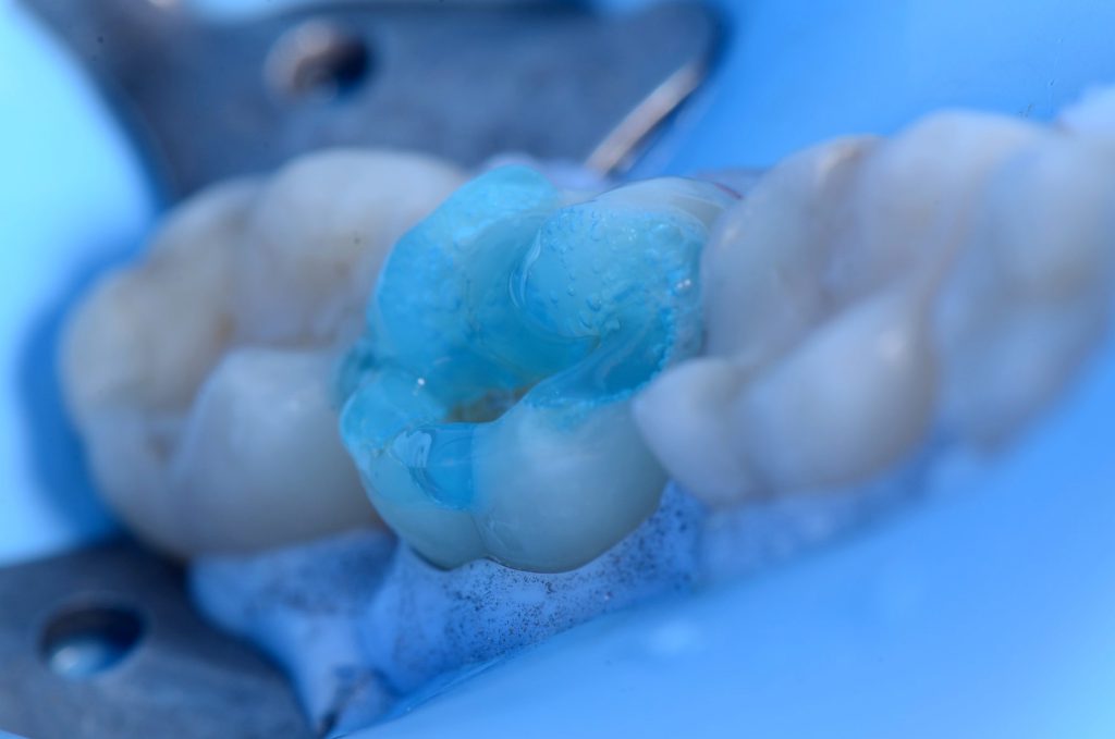 3A - Por que utilizar o ácido fosfórico nas restaurações dentárias?