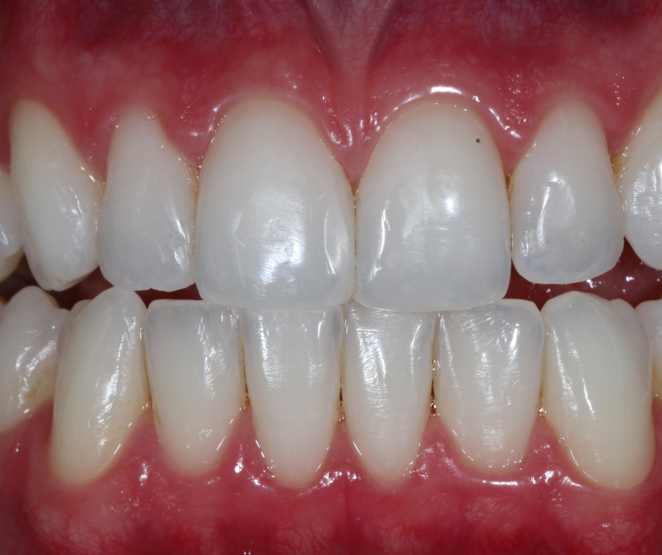 4u6kmd1ljd 7 - Fechamento de diastema e alteração de contorno de incisivos laterais com resina unicromática