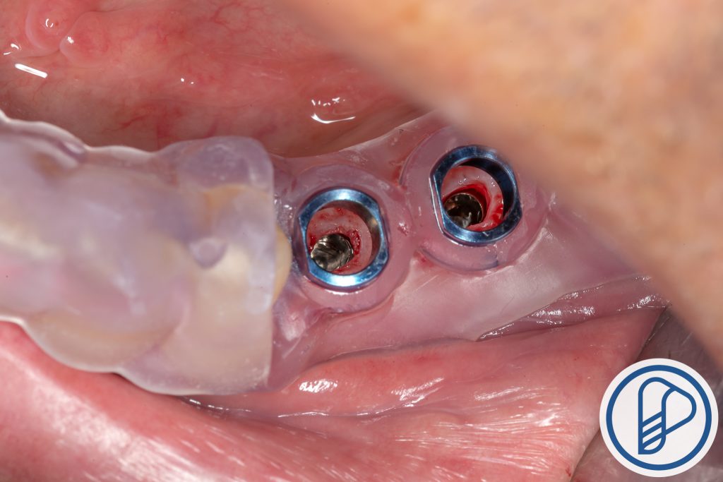 5ri3mapnep IMG 1156 - Instalação de Implantes: Cirurgia Guiada Sem Retalho X Cirurgia Convencional