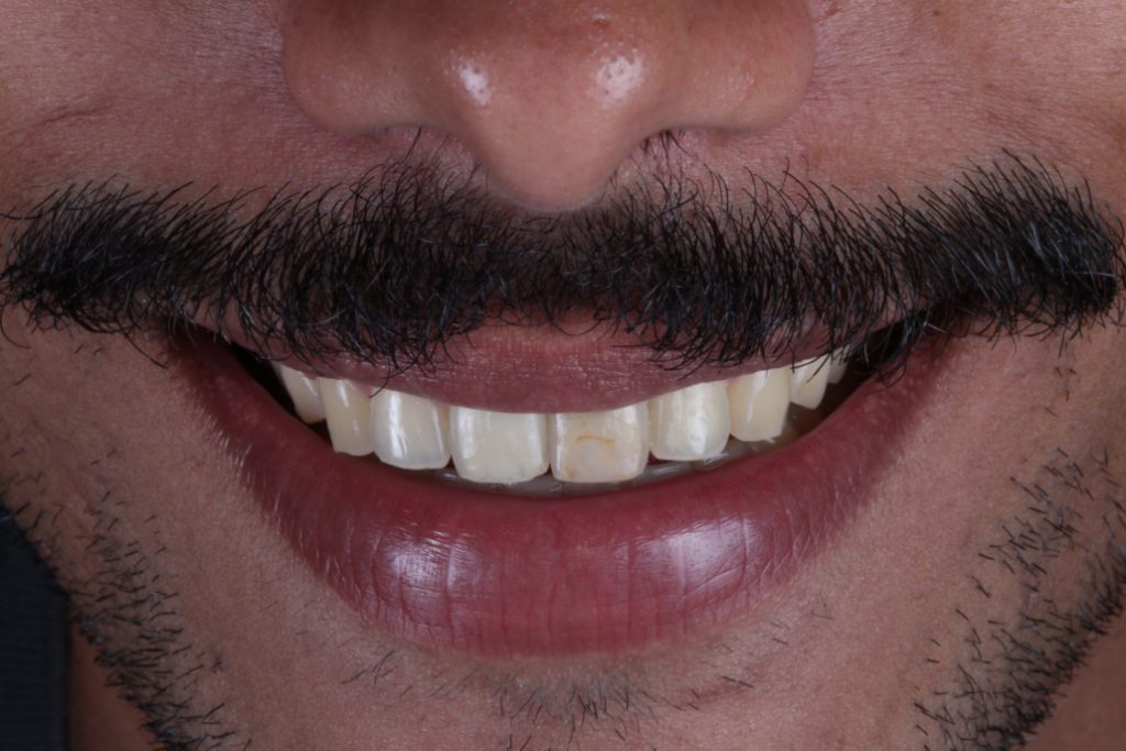 6w2ajeh4ze IMG 1143 1030x687 - Clareamento interno e Faceta direta em resina composta: Solução para dentes escurecidos