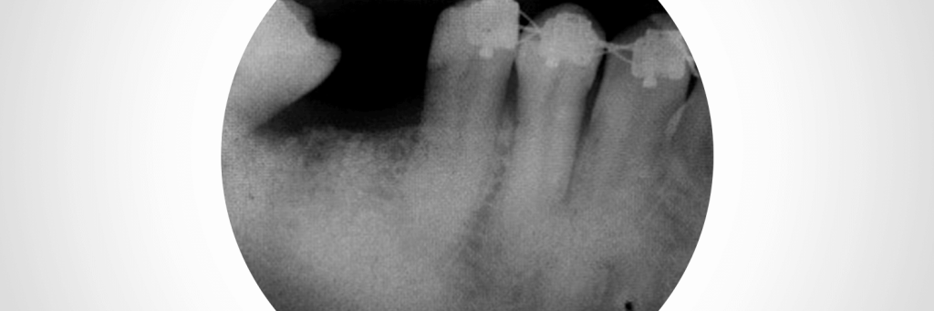 74tg8qbwvh Blog 1 1 - Preenchimento alveolar com enxerto ósseo sintético