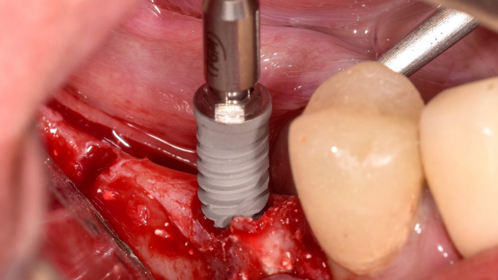 DSC 0071 scaled 1 - Exodontia e preservação alveolar com Nanosynt e posterior reabilitação com implantes Vezza