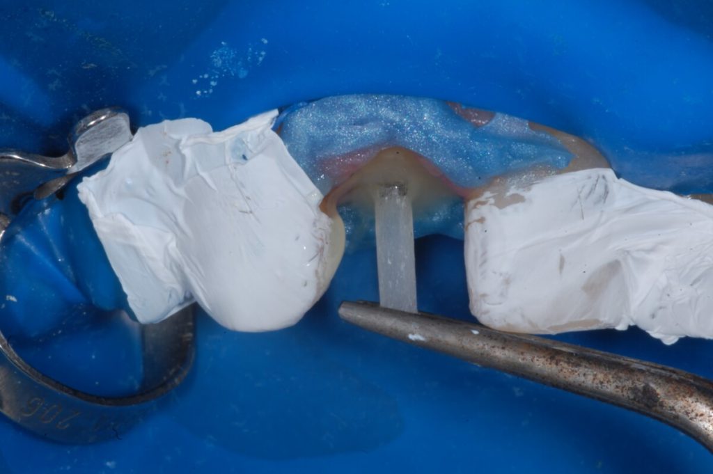 Figura14 e1607350599893 - Reconstrução de dentes tratados endodonticamente com pino de fibra de vidro e coroa em dissilicato de lítio