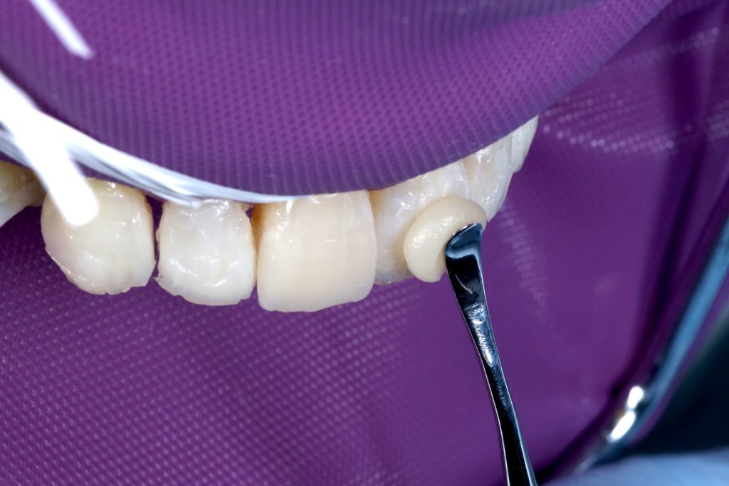 Foto 12 - Por que o tempo de trabalho de uma resina dental é tão importante?