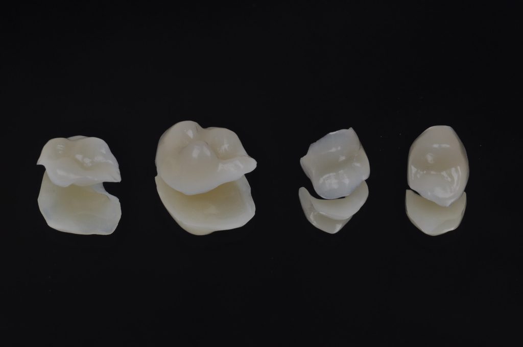 Imagem7 - Versatilidade e estética em reabilitação de dentes posteriores com Brava Block