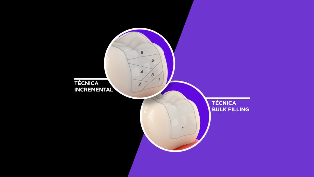 tecnica incremental - Incremental technique or Bulk Fill?