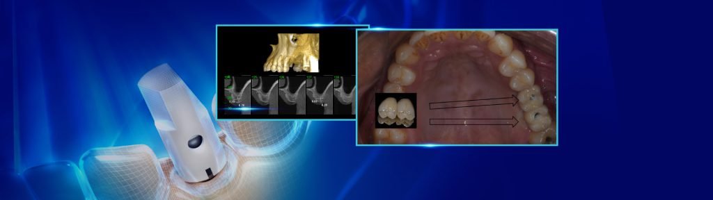 levantamento de seio maxilar - Levantamento de seio maxilar com instalação concomitante de Implantes: relato de caso clínico