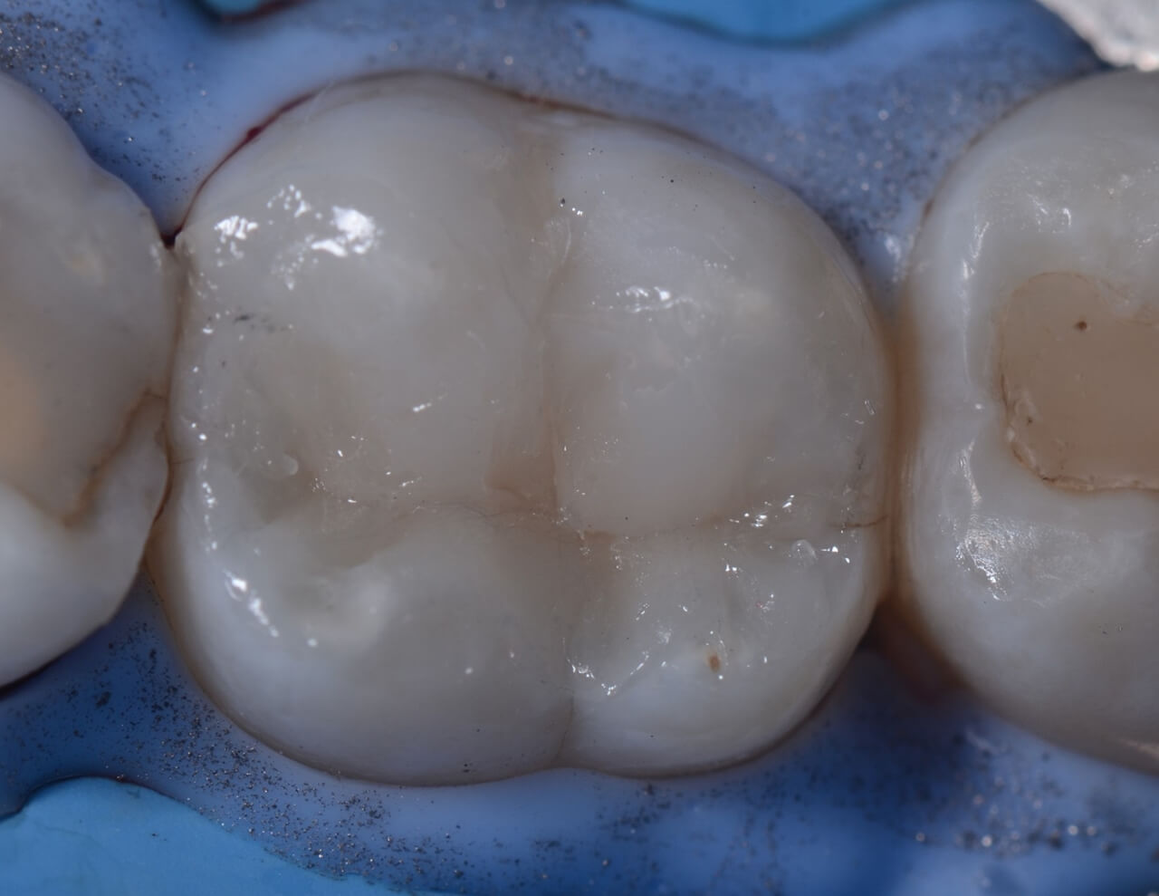 Orthodontic cement Orthocem FGM Dental Group
