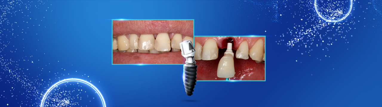 Implante imediato com carga imediata sobre cicatrizador personalizando area peri implantar1 - Immediate implant placement with immediate loading on healing abutment, customizing peri-implant area