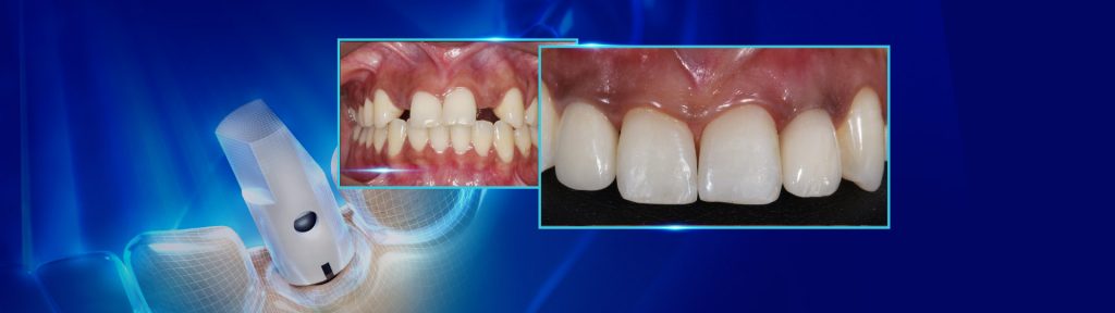 Reconstrucoes osseas e implantacoes com guia prototipada em areas de agenesia 11 - Bone reconstruction and implantations with prototyped guide in agenesia areas