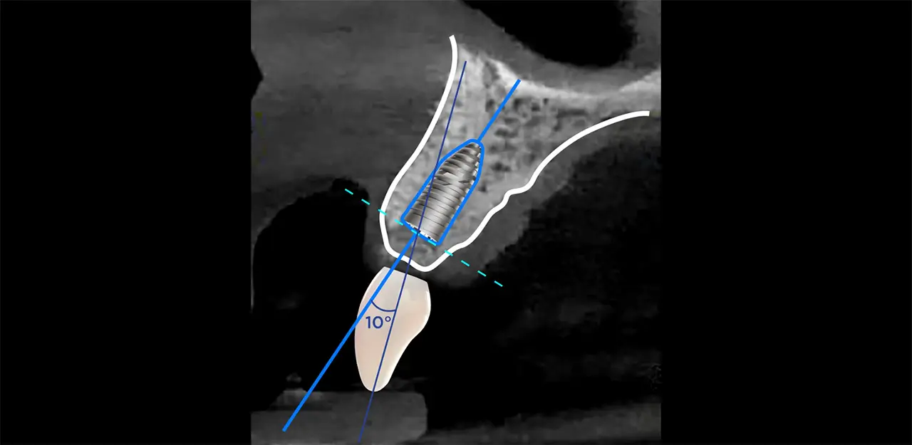 passo-1-exame-clinico-tomografia-e-radiografia-planejamento-e-impressão-da-guia