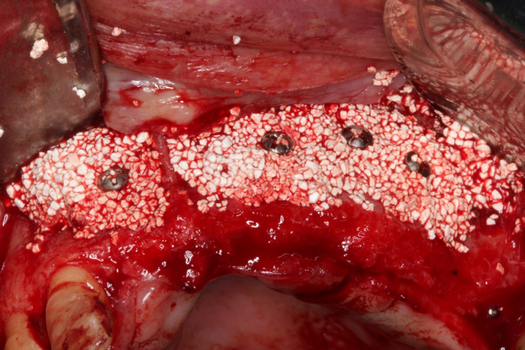 Fig13 e16081416529871 - Reconstruction of the atrophic maxilla using allogeneic graft and fibrin rich in platelets and leukocytes