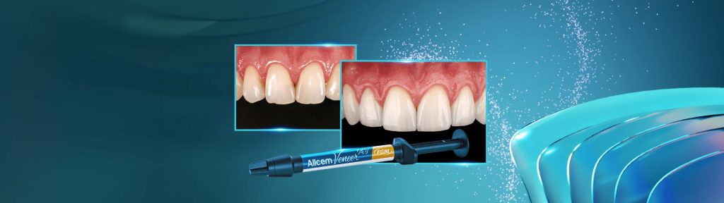 Restabelecimento do corredor bucal e do sorriso com cirurgia plastica periodontal e laminados ceram3 - Restablecimiento del corredor bucal y de la sonrisa con cirugía plástica periodontal y laminados cerámicos