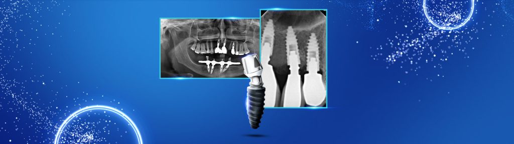 banner Implante Imediato – Praticidade Clinica e Conforto ao Paciente1 - Implante inmediato, practicidad clínica y confort al paciente