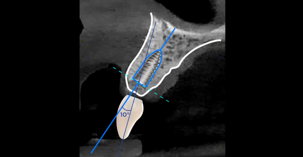 CGA passo a passo 1 1 e1675192074764 - Por que optar pela utilização da Cirurgia Guiada?