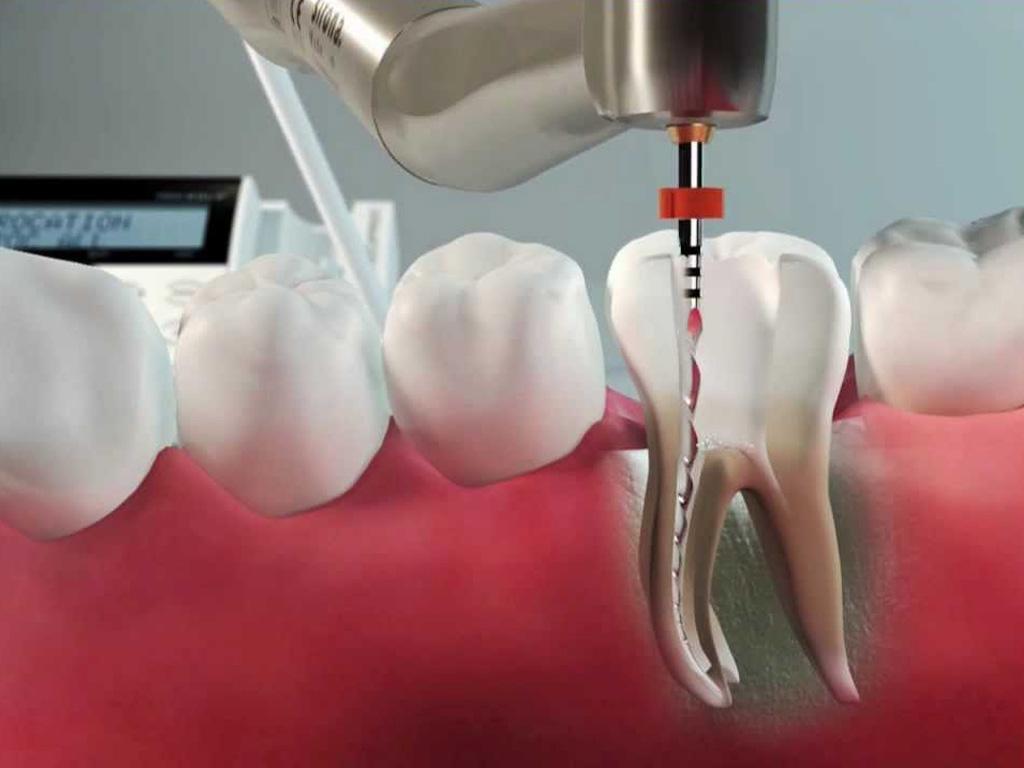 saiba como a tecnologia faz a diferenca no tratamento de canal - A anatomia surpreendente dos dentes: descubra como até quatro canais podem afetar sua saúde bucal