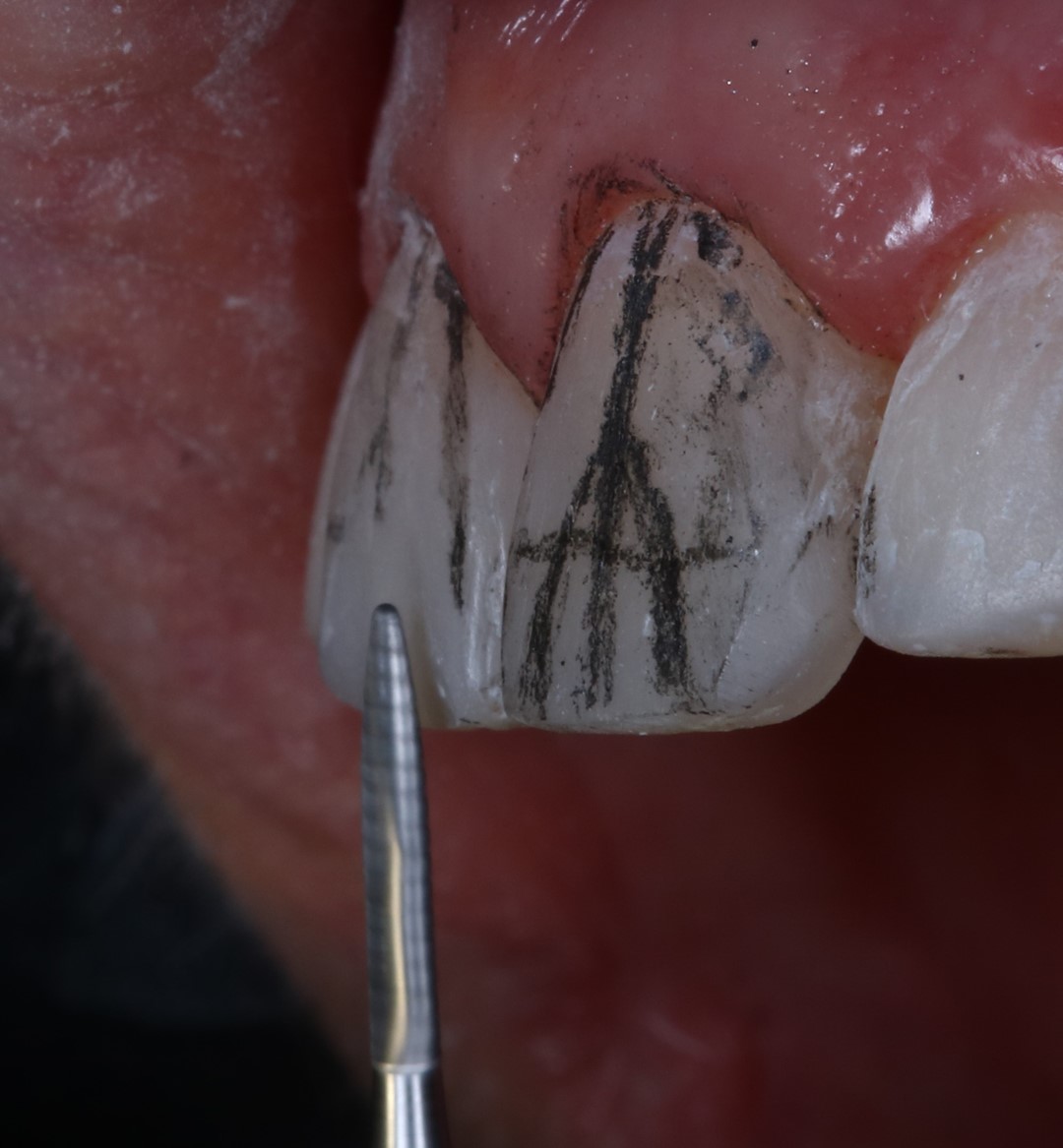 Fig. 14 – Acabamento das facetas com broca multilaminada - 10 facetas superiores em resina Vittra APS