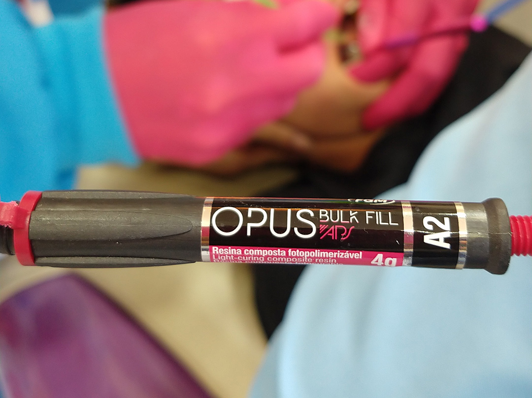 Fig. 9 – Segunda camada com Resina Opus Bulk Fill APS A2 FGM - Recuperação da função dentária e estética em paciente autista odontopediátrico