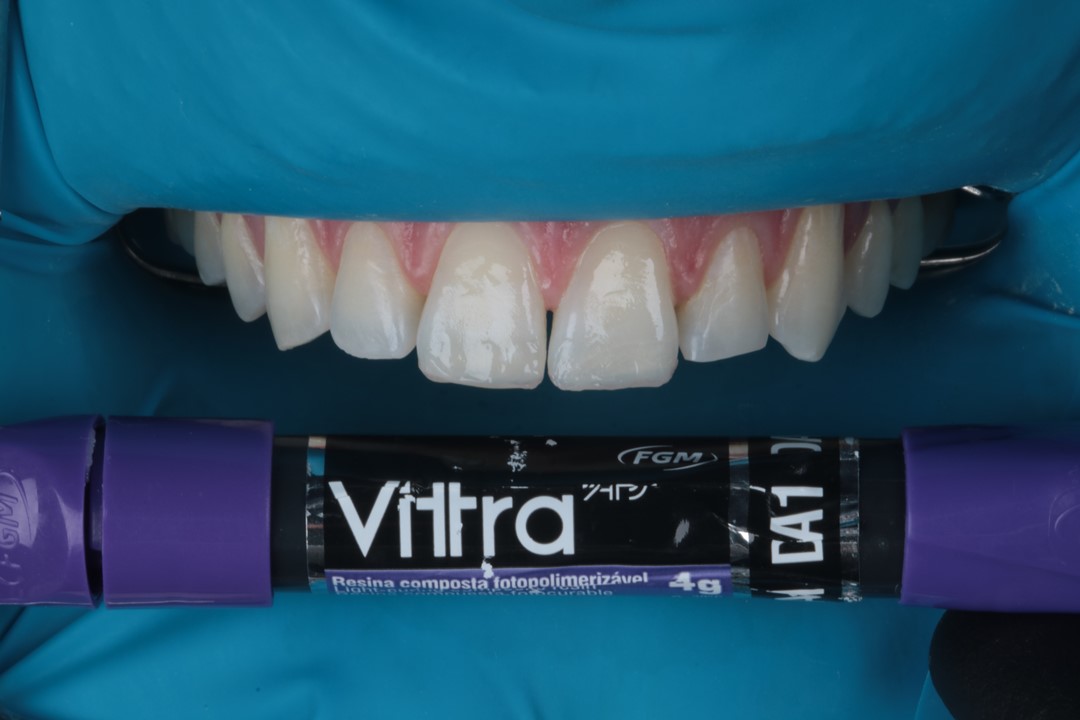 Fig. 10 – Inserção de incremento de resina Vittra APS DA1 para equalizar o substrato.