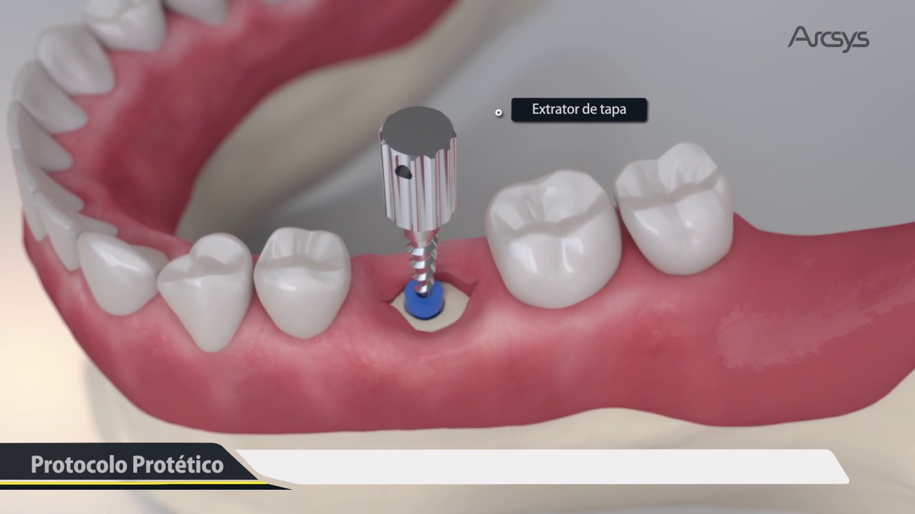 procedimento cirurgico 3d arcsys - Impulsionando seu Consultório: Explore as Últimas Tendências em Implantodontia