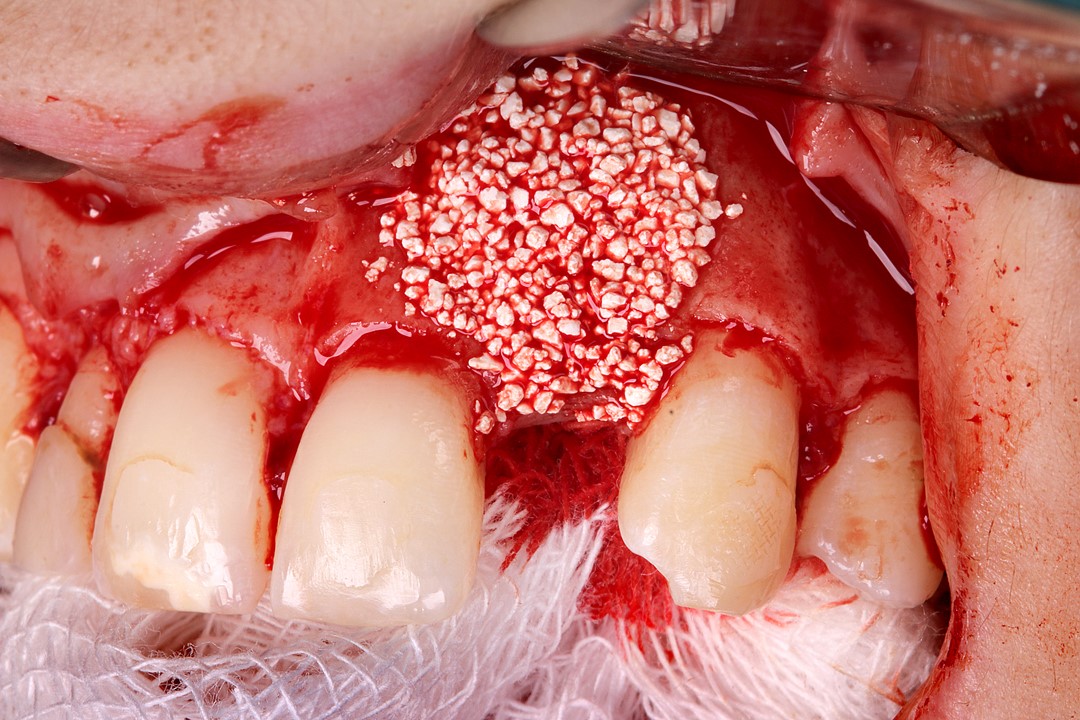 8 - Guided bone regeneration in aesthetic area