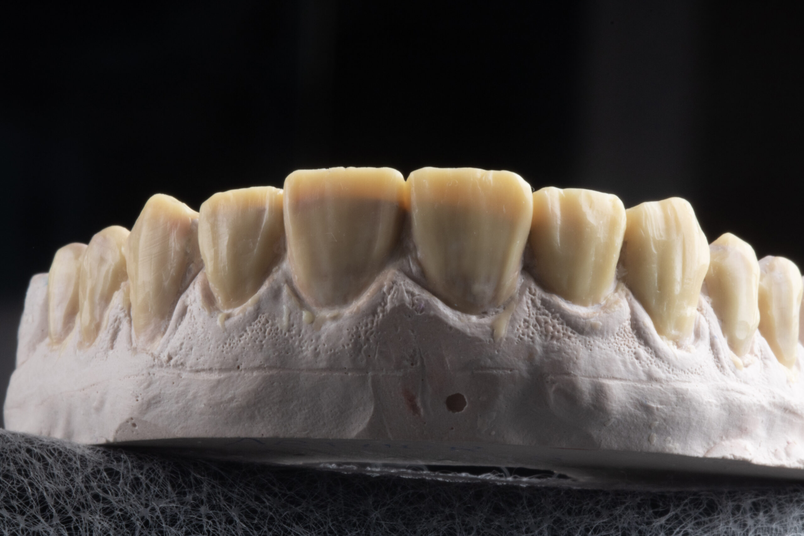 Direct veneers for rehabilitation in teeth worn by bruxism