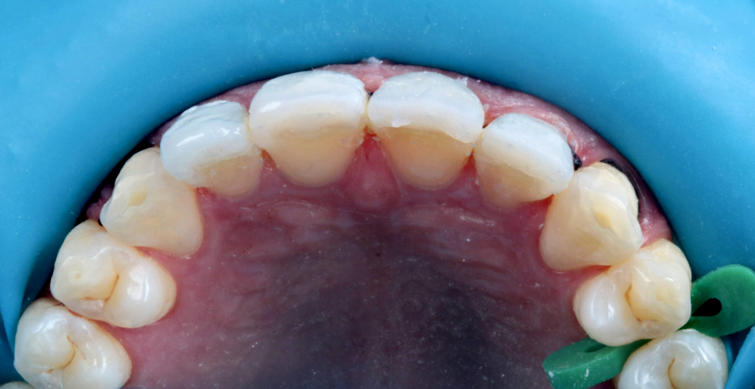 Direct veneers for rehabilitation in teeth worn by bruxism