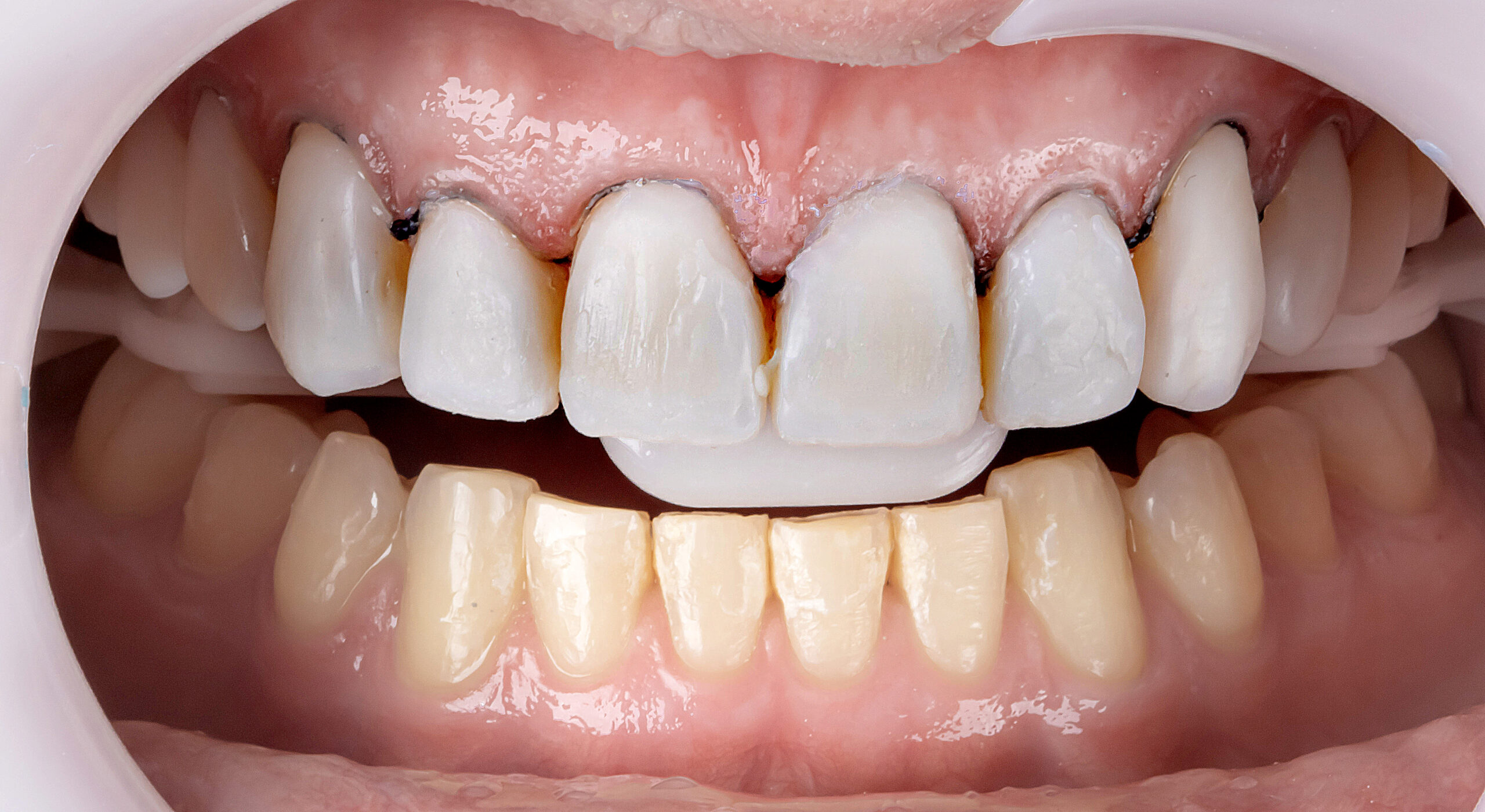 Direct veneers for rehabilitation in teeth worn by bruxism