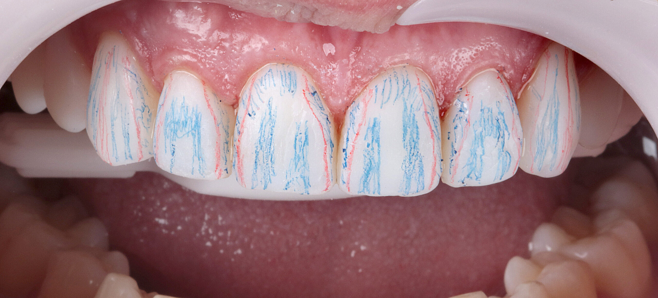 Direct veneers for rehabilitation in teeth worn by bruxism