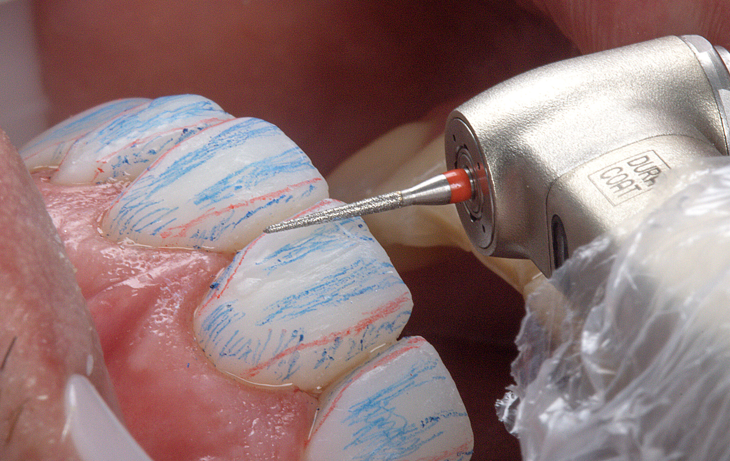 Direct veneers for rehabilitation in teeth worn by bruxism