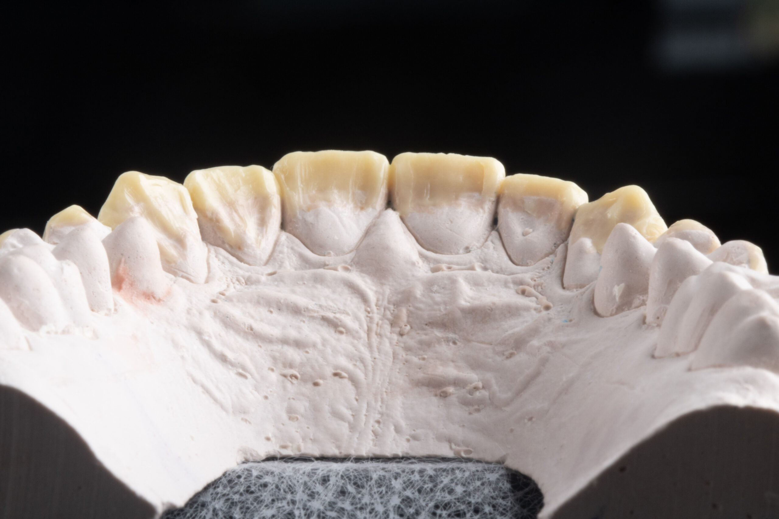 Direct veneers for rehabilitation in teeth worn by bruxism