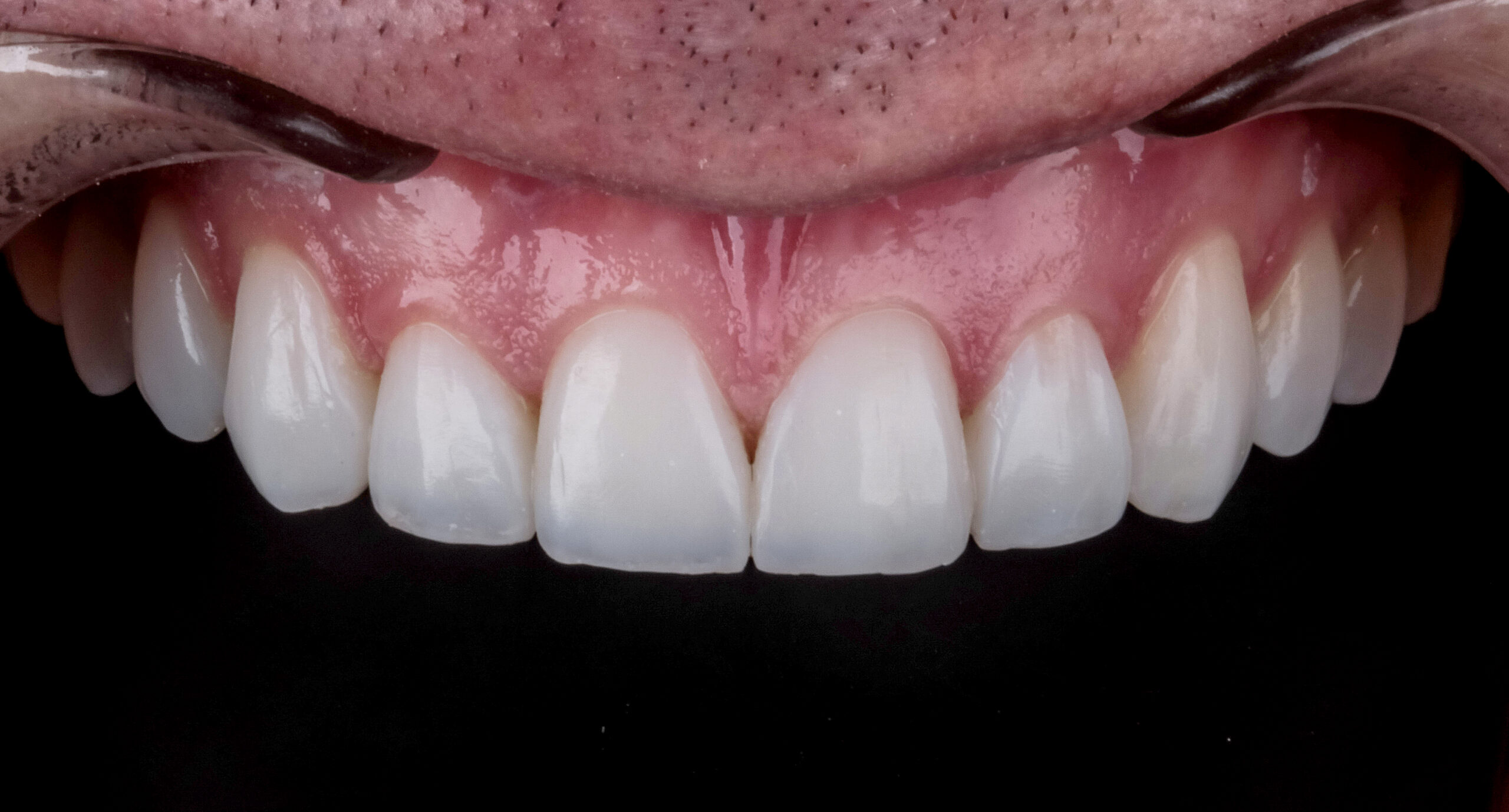 Direct veneers for rehabilitation in teeth worn by bruxism