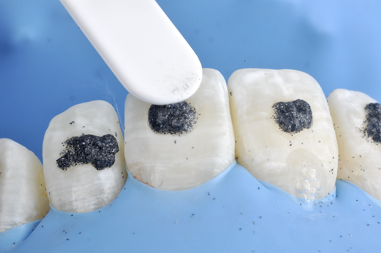 Athome whitening and microabrasion