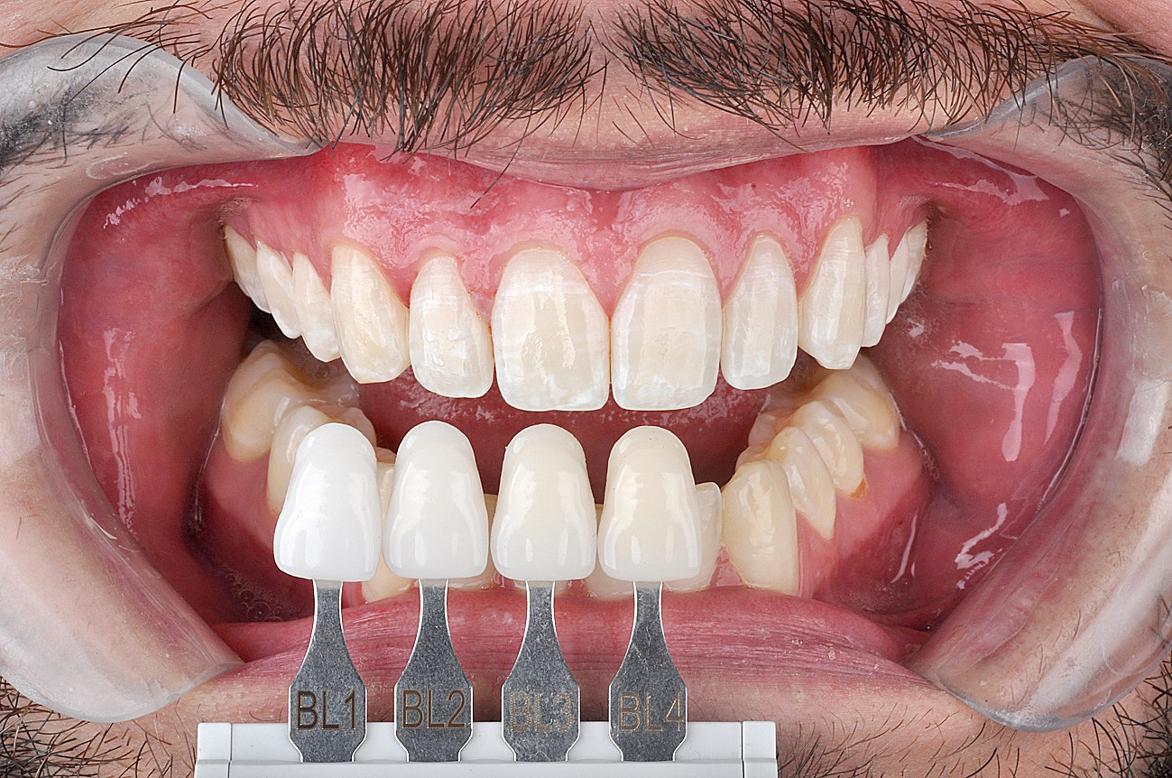 Athome whitening and microabrasion