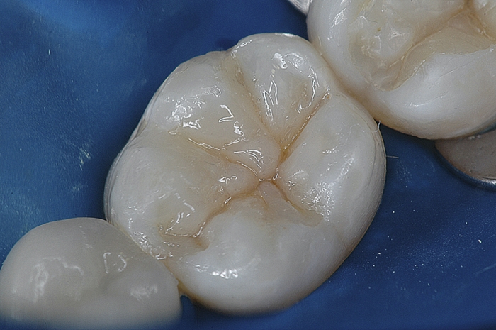 06 - Substituição de restaurações de resina composta em dentes posteriores