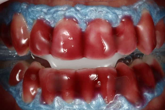 Cobertura fina da face vestibular dos dentes com Whiteness HP Maxx (FGM).