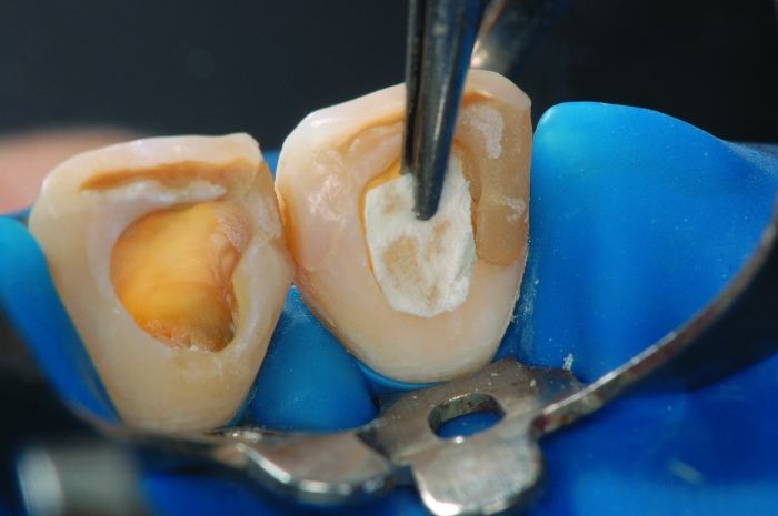 11 - Otimizando a estética de dentes escurecidos após tratamento endodôntico por meio de clareamento interno