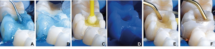 Sequência clínica do condicionamento ácido, aplicação do adesivo e incrementos de resina iniciais em outra vista