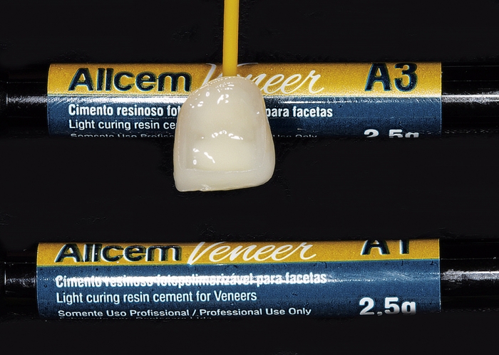 Cimento Resinoso Fotopolimerizável Allcem Veneer cor A3 na cervical e A1 na incisal