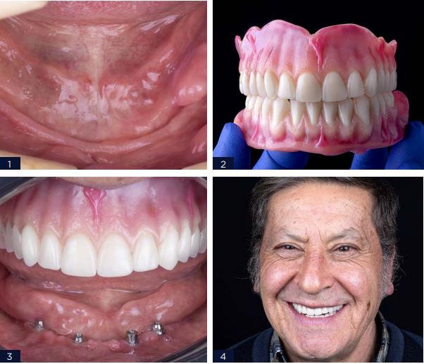 OVERDENTURE SMART SOBRE - Arcsys pelo mundo